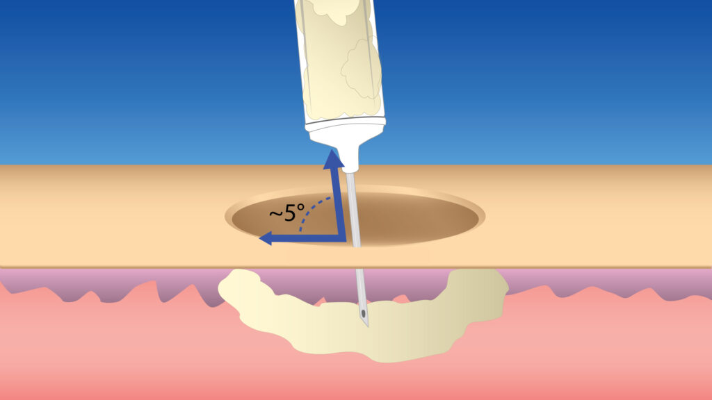 *Fig. 2 - Dr. Shah's Microsweep Technique 