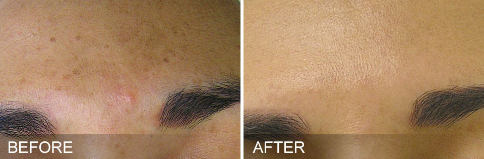 Before & After Brown Spots