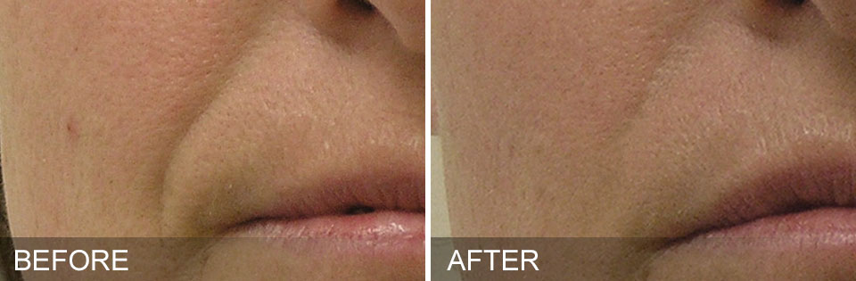 Before & After Nasolabial folds