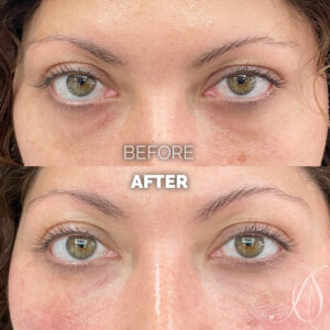 Aesthetic_Skin_Chicago_Fillers_Under_Eye_Filler_02